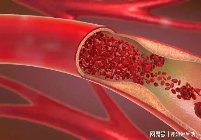 人有没有血栓，睡觉就知道？体内有血栓的人，睡觉常有这个表现