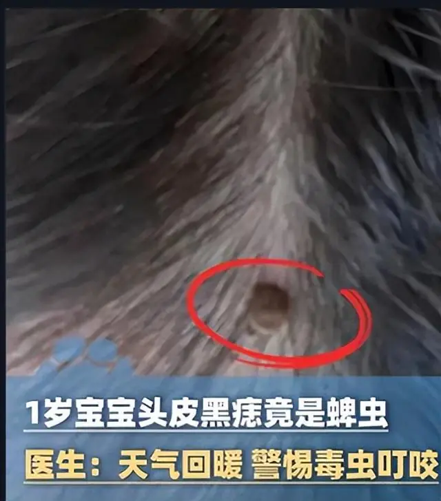 蜱虫钻入孩子头皮，家长用手抠没用才送医院，医生怒斥父母：没点常识！蜱虫很毒已经害死很多人了