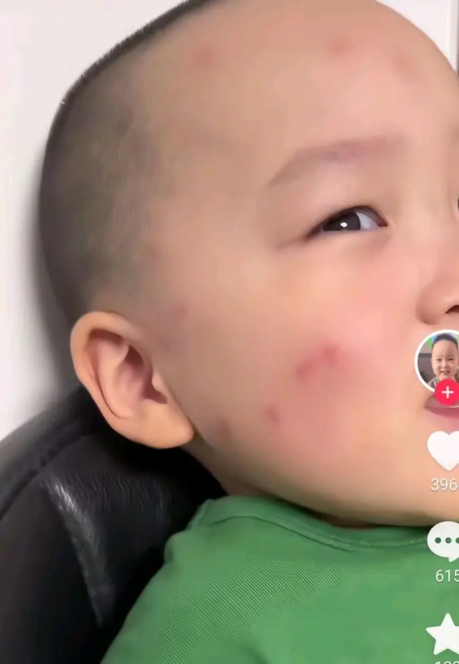 东北3岁网红小吃播脸上被蚊子咬了包，看起来胖了很多