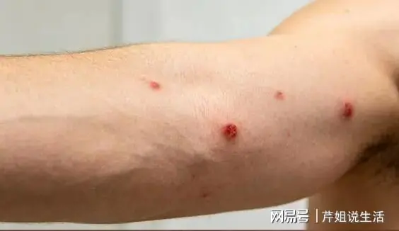 身上长红痣，代表肝病来临？医生：肝开始病变，身体或有4种变化